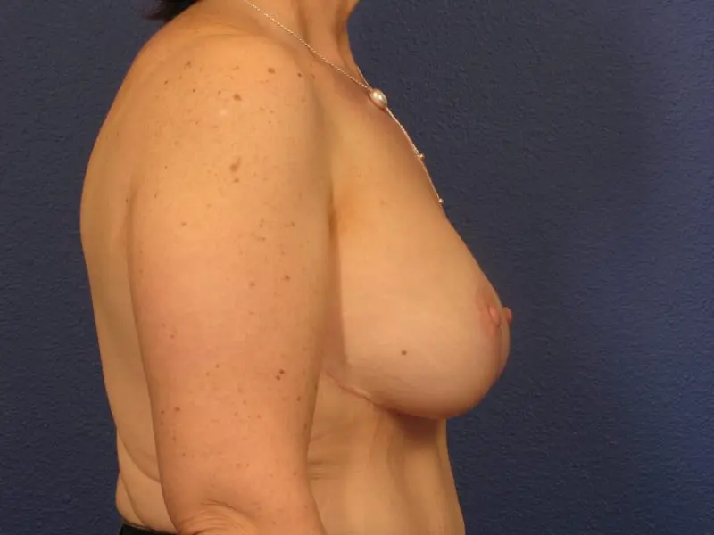 After Major Weight Loss - Case 179 - After