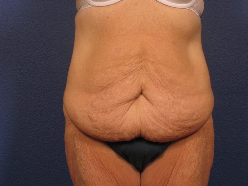 After Major Weight Loss Patient Photo - Case 181 - before view-5