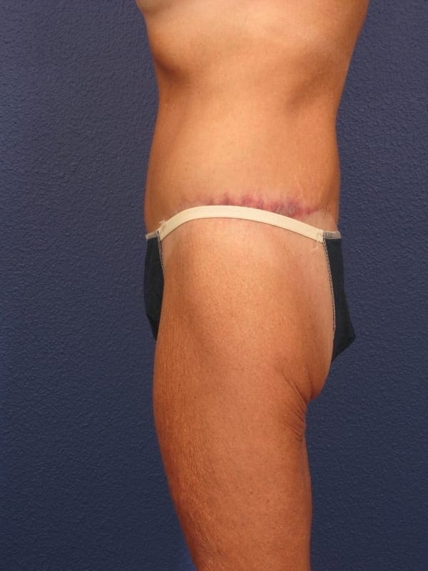 After Major Weight Loss Patient Photo - Case 181 - after view-4