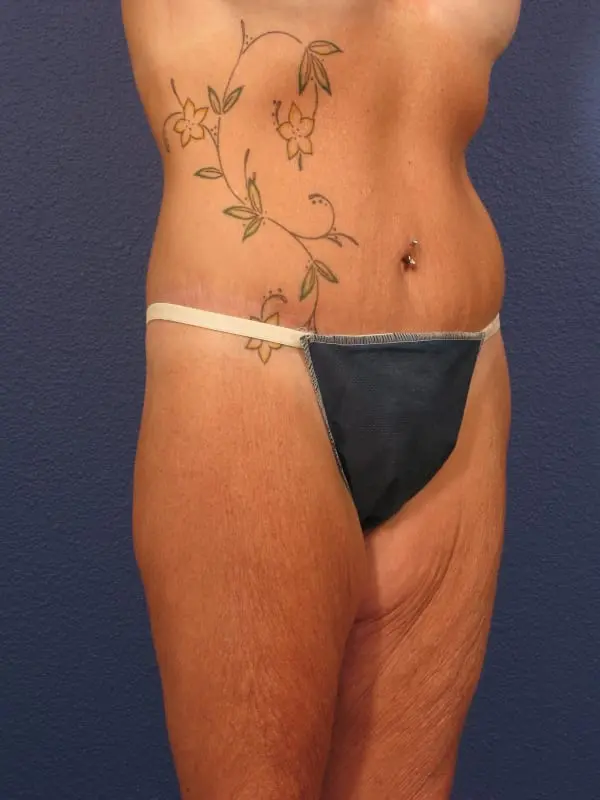 After Major Weight Loss Patient Photo - Case 181 - after view-3