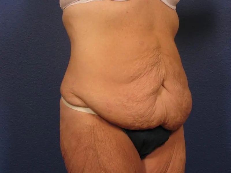 After Major Weight Loss Patient Photo - Case 181 - before view-3
