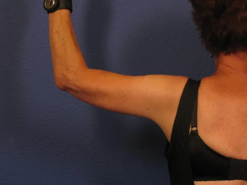 Arm, Thigh and Butt Lift - Case 183 - Before