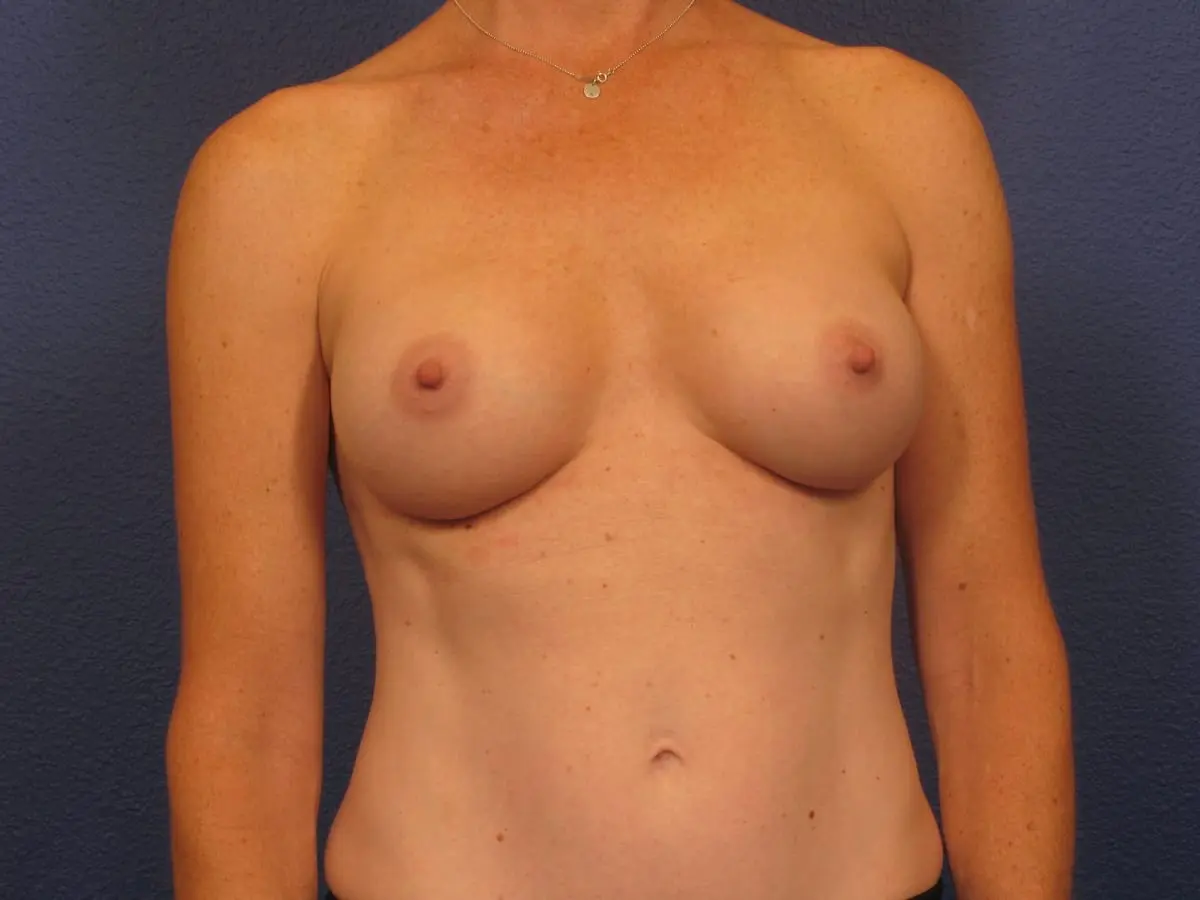 Breast Augmentation - Case 187 - After