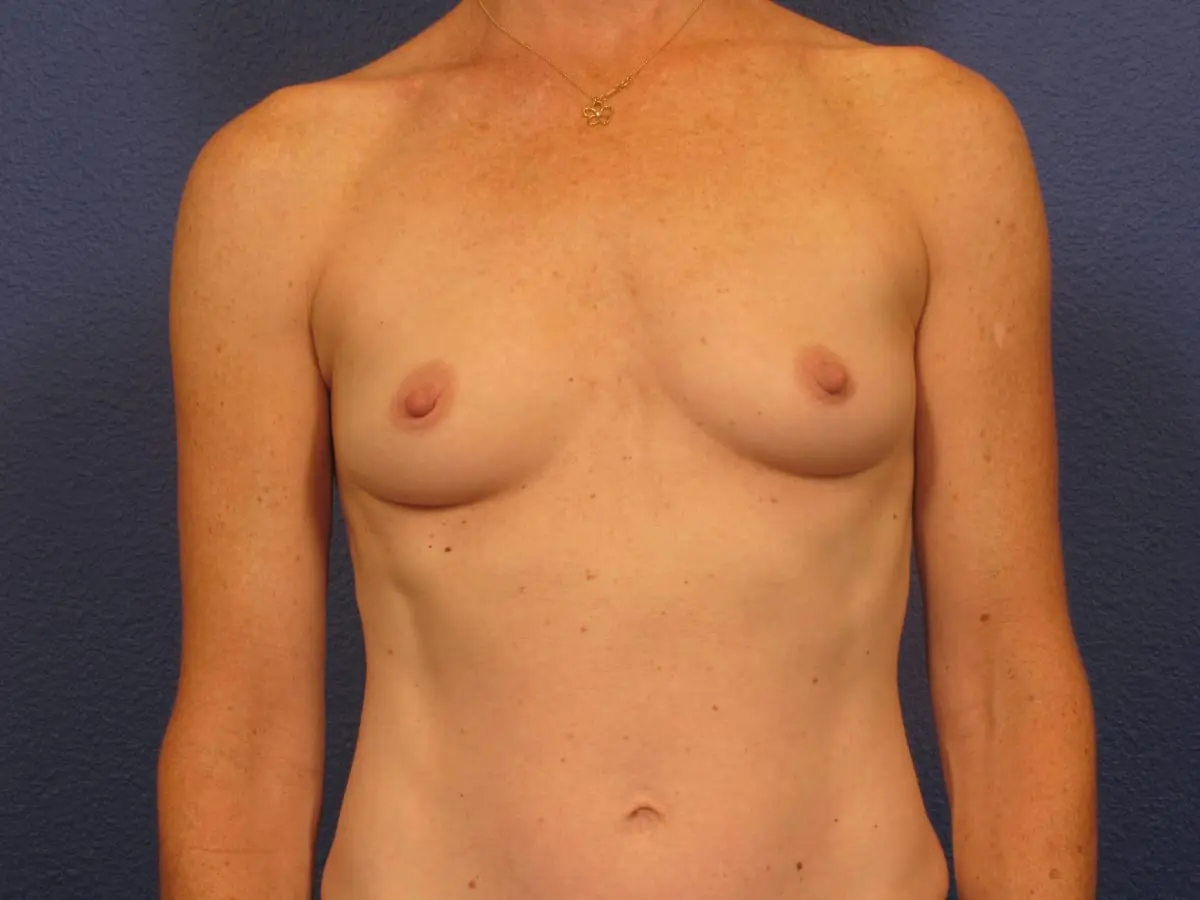 Breast Augmentation Patient Photo - Case 187 - before view-2