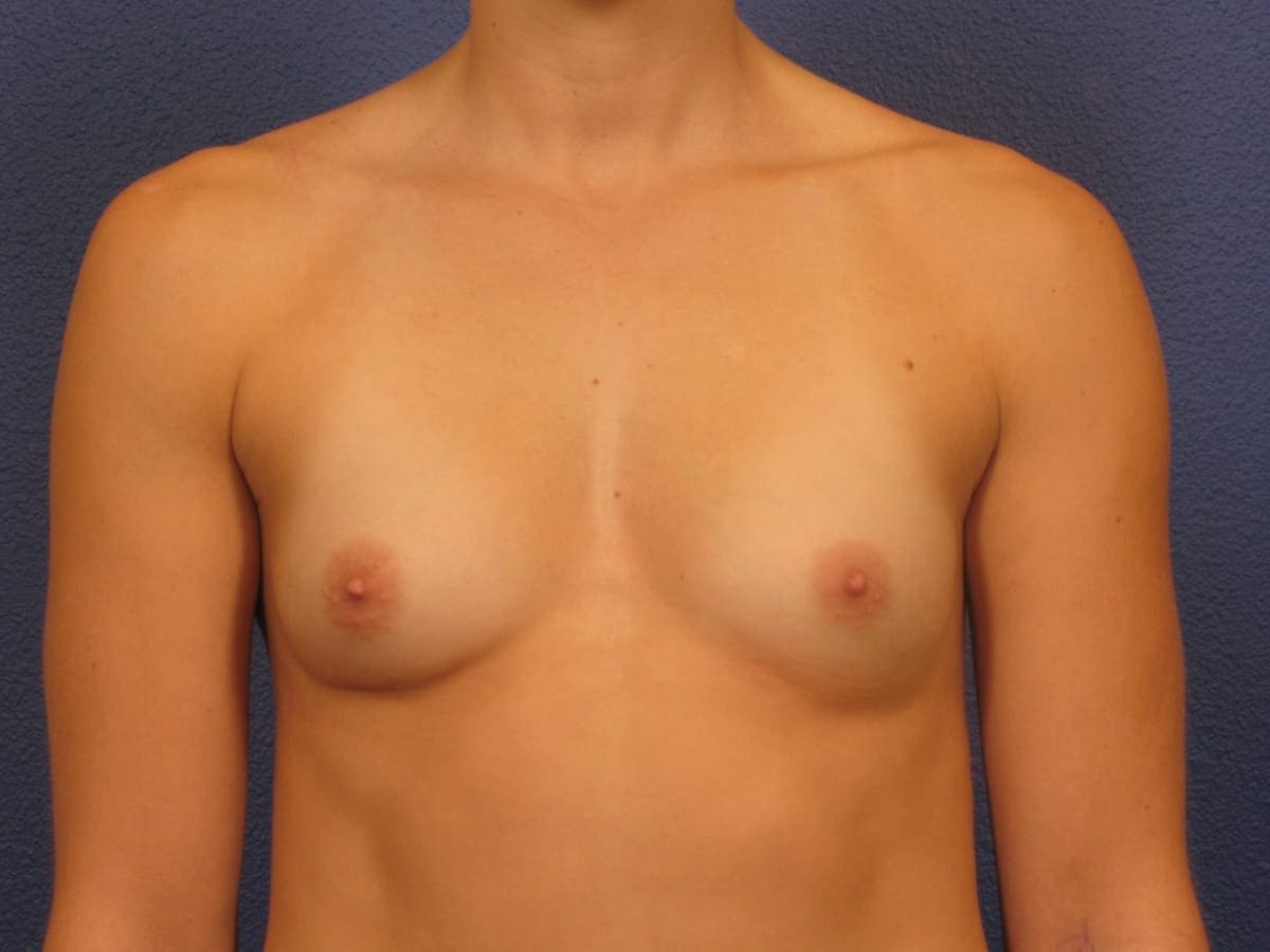 Breast Augmentation Patient Photo - Case 196 - before view-2