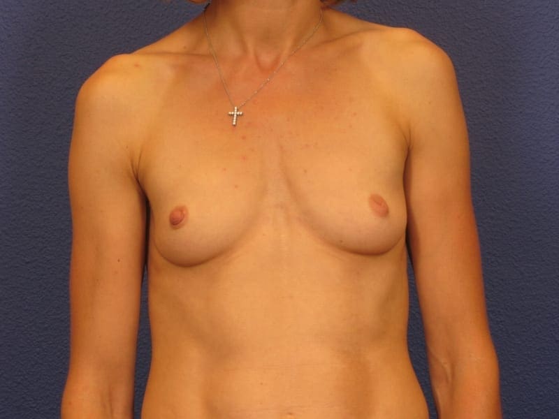 Breast Augmentation Patient Photo - Case 204 - before view-2
