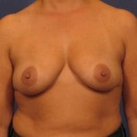 Breast Augmentation - Case 211 - Before