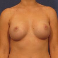 Breast Augmentation - Case 213 - After