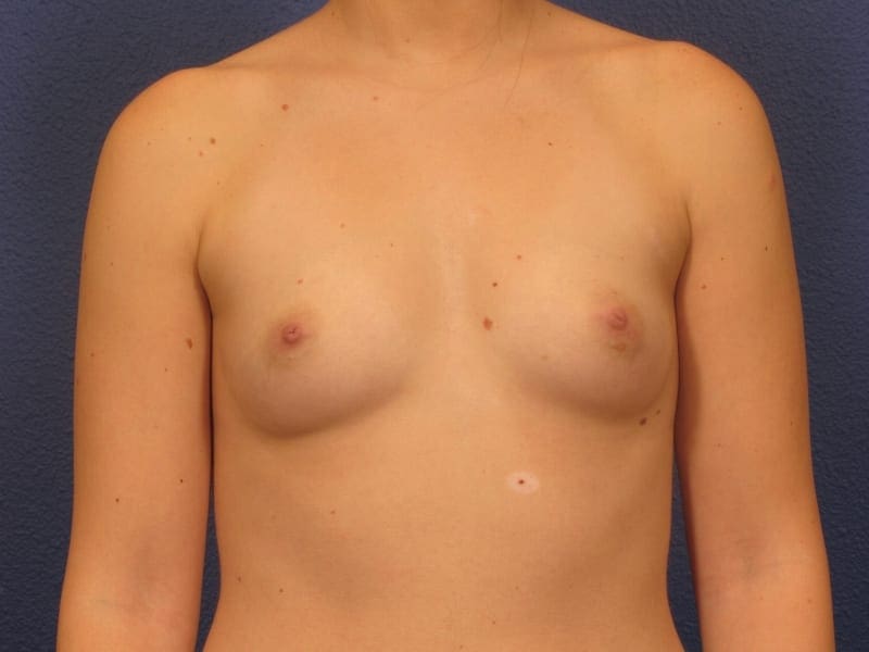 Breast Augmentation Patient Photo - Case 213 - before view-2