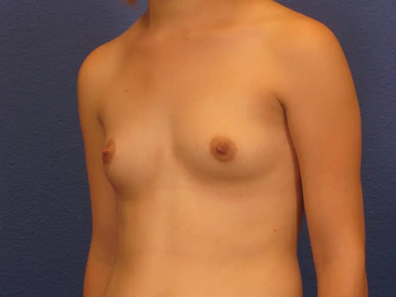 Breast Augmentation Patient Photo - Case 214 - before view-1