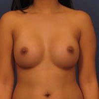 Breast Augmentation - Case 225 - After