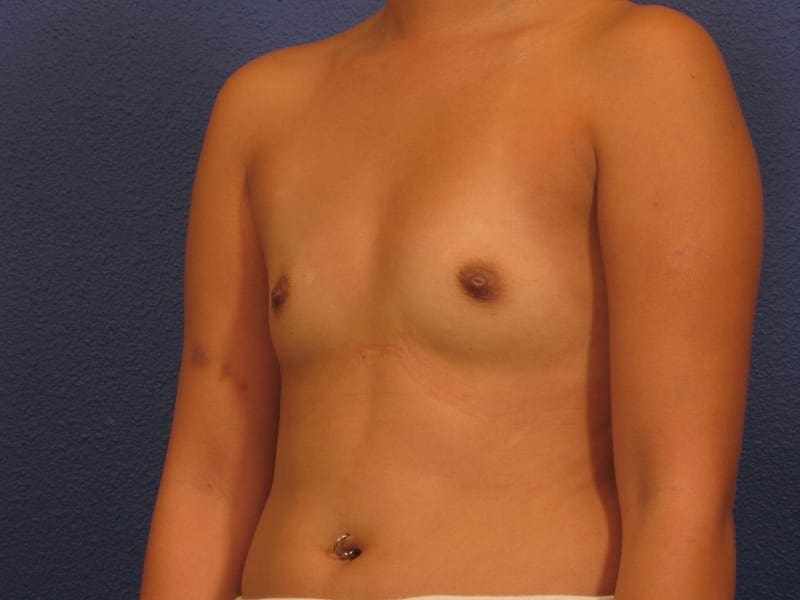 Breast Augmentation Patient Photo - Case 225 - before view-1