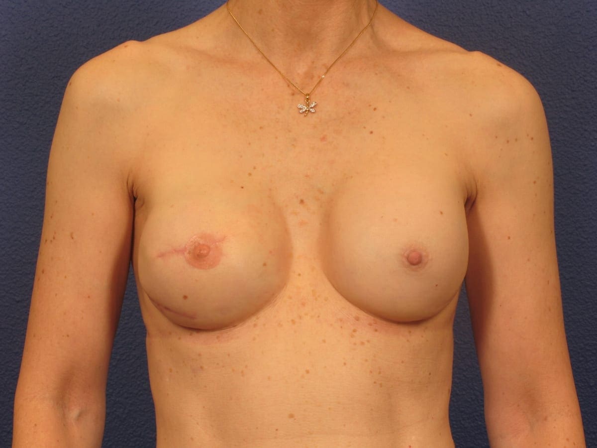 Breast Reconstruction - Case 240 - After