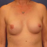 Breast Reconstruction - Case 242 - After