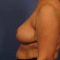 Breast Reduction - Case 245 - Before