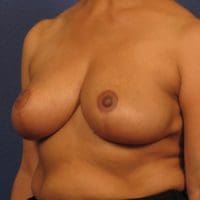 Breast Reduction - Case 245 - After