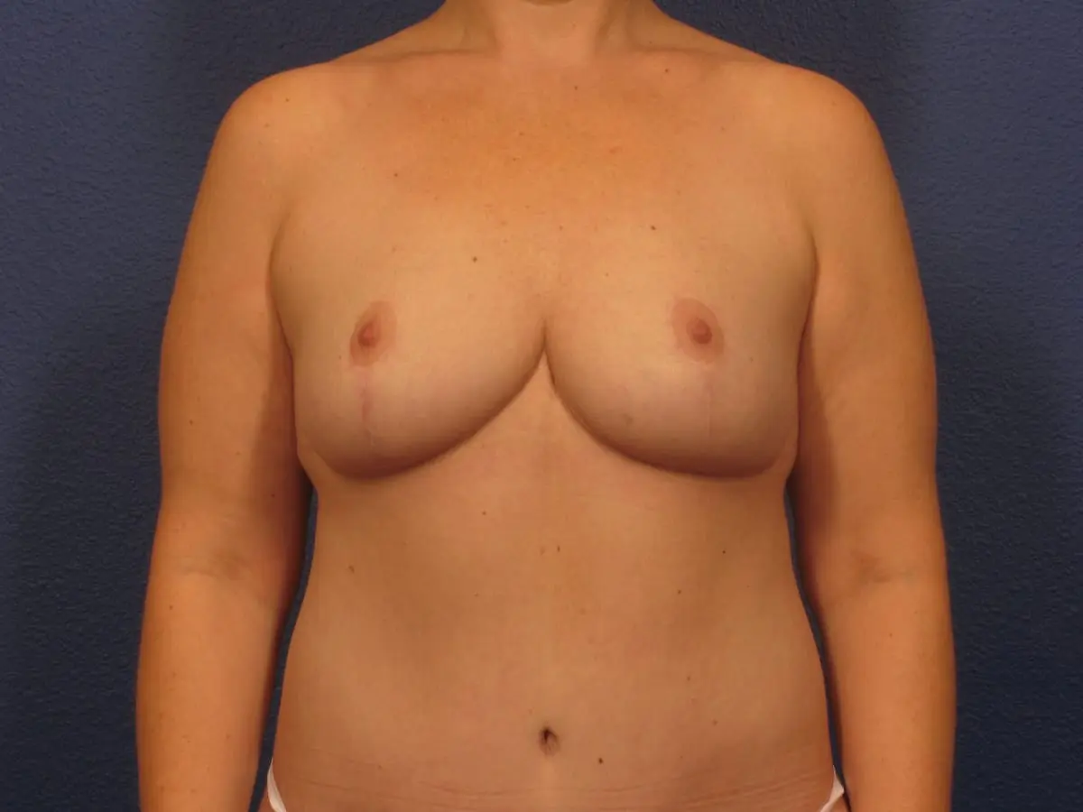 Breast Reduction - Case 247 - After