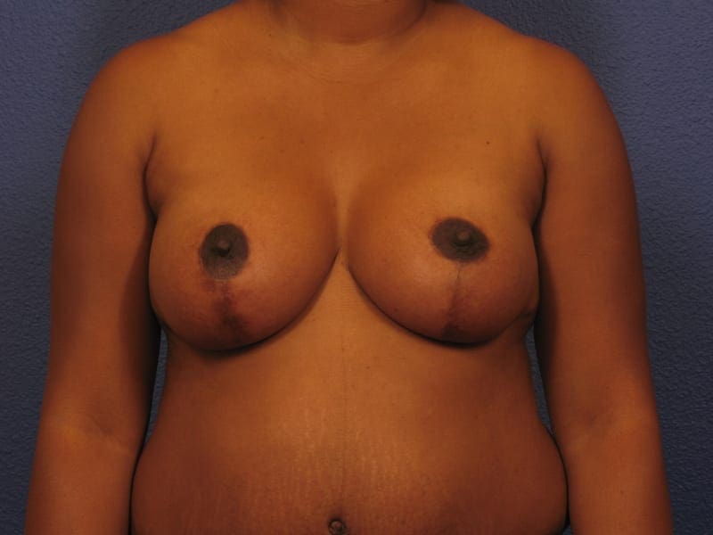 Breast Reduction Patient Photo - Case 248 - after view