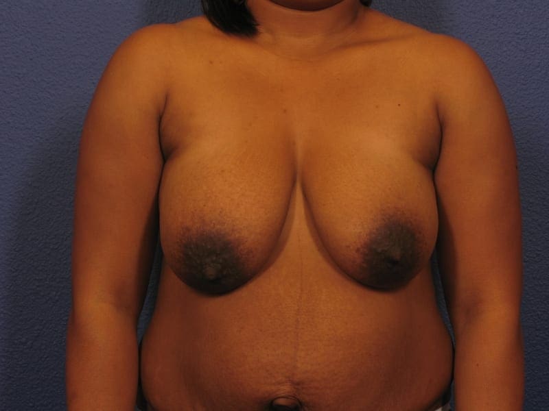 Breast Reduction - Case 248 - Before