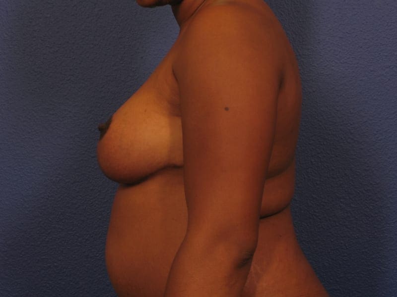 Breast Reduction Patient Photo - Case 248 - after view-1