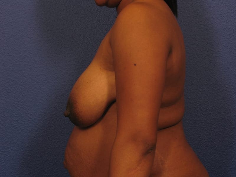 Breast Reduction Patient Photo - Case 248 - before view-1