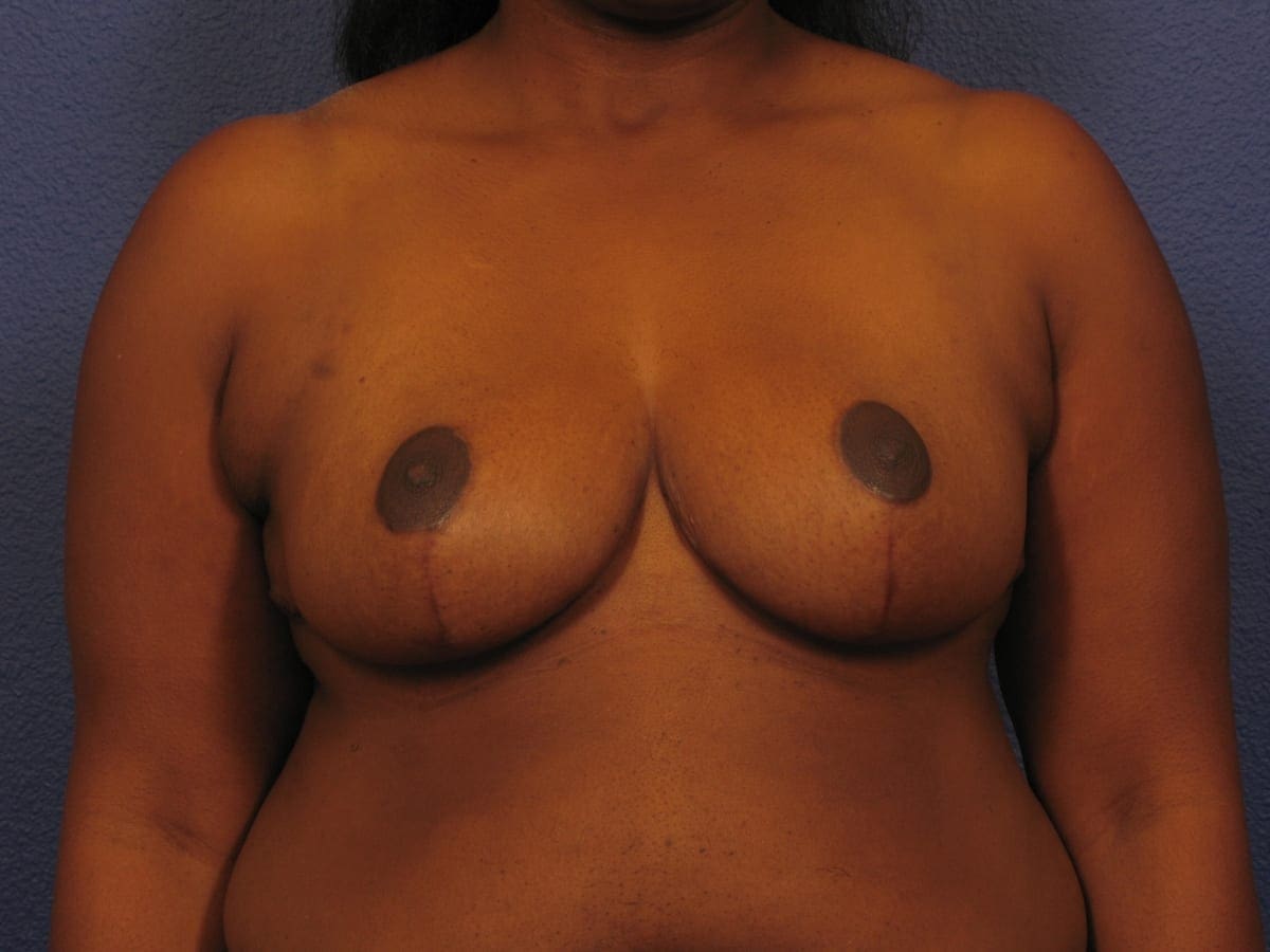 Breast Reduction Patient Photo - Case 250 - after view-2
