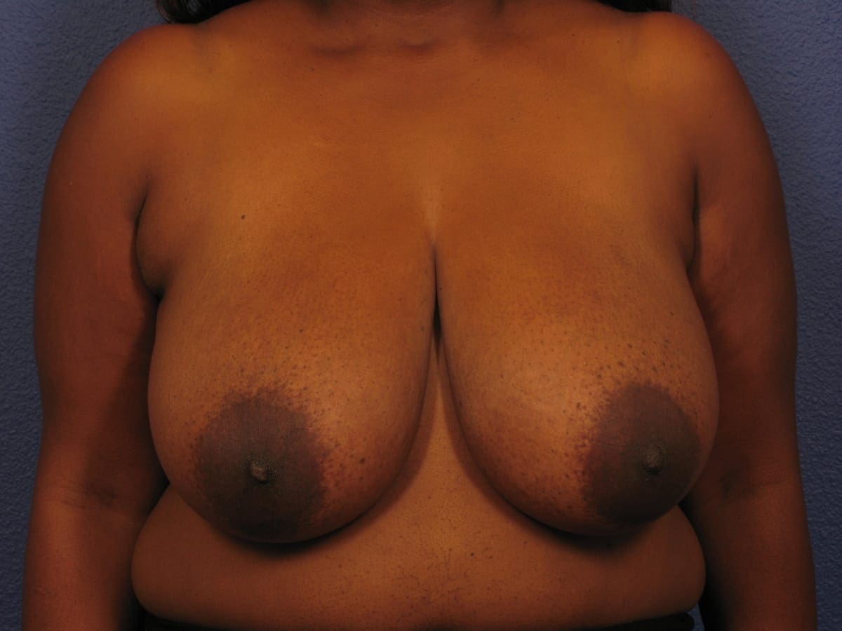Breast Reduction Patient Photo - Case 250 - before view-2