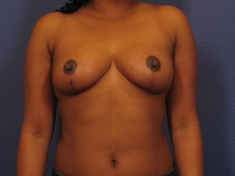 Breast Reduction - Case 252 - After