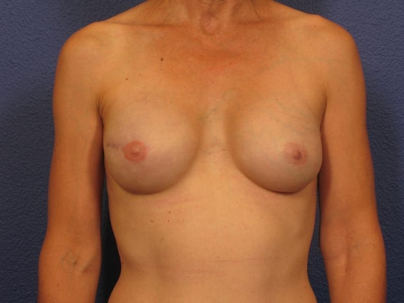 Breast Revision Patient Photo - Case 262 - after view-2