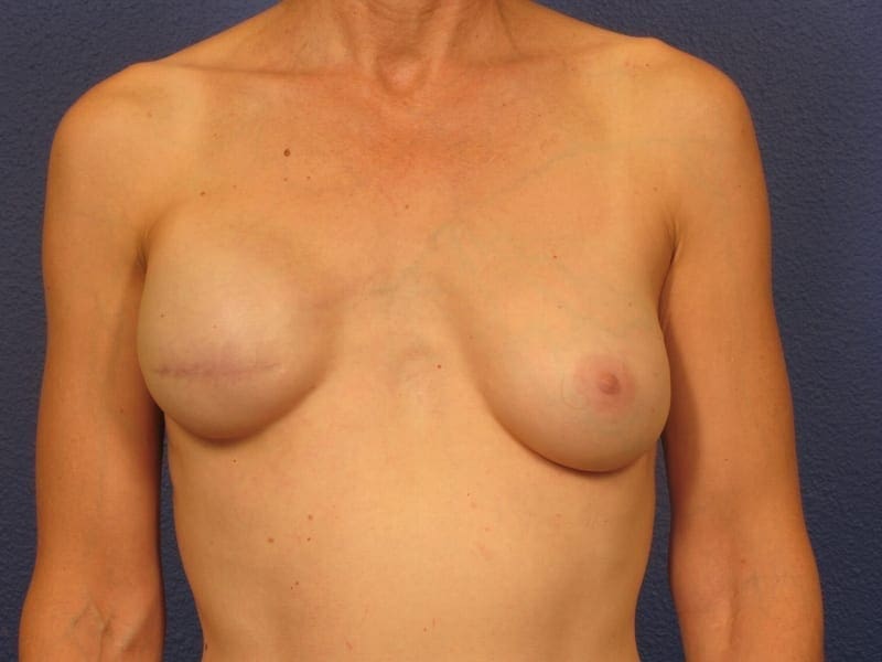 Breast Revision Patient Photo - Case 262 - before view-2