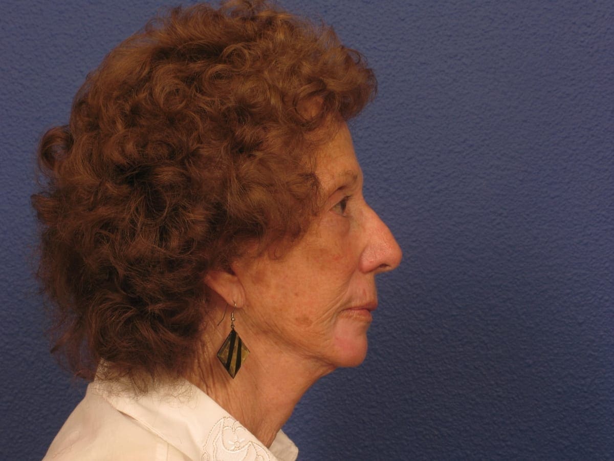 Facelift Patient Photo - Case 279 - after view-1