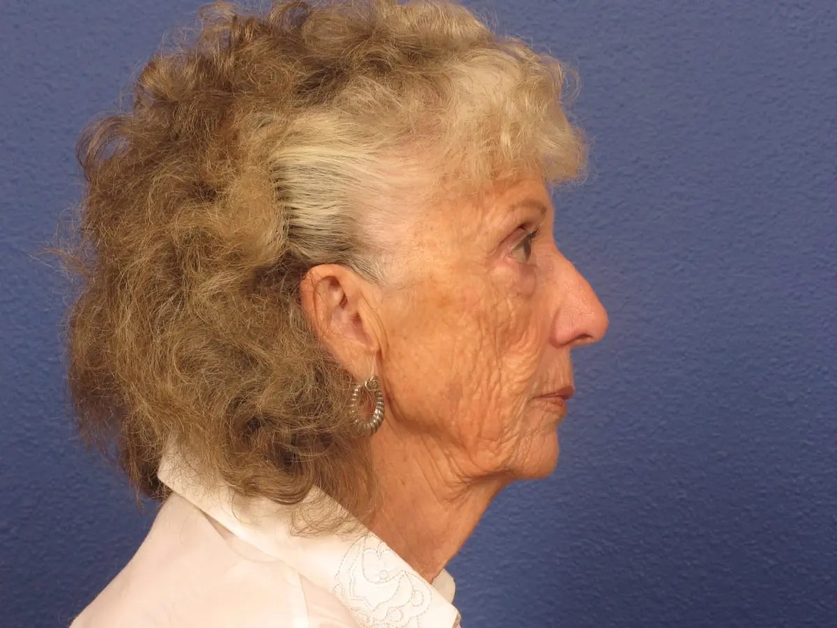 Facelift Patient Photo - Case 279 - before view-1