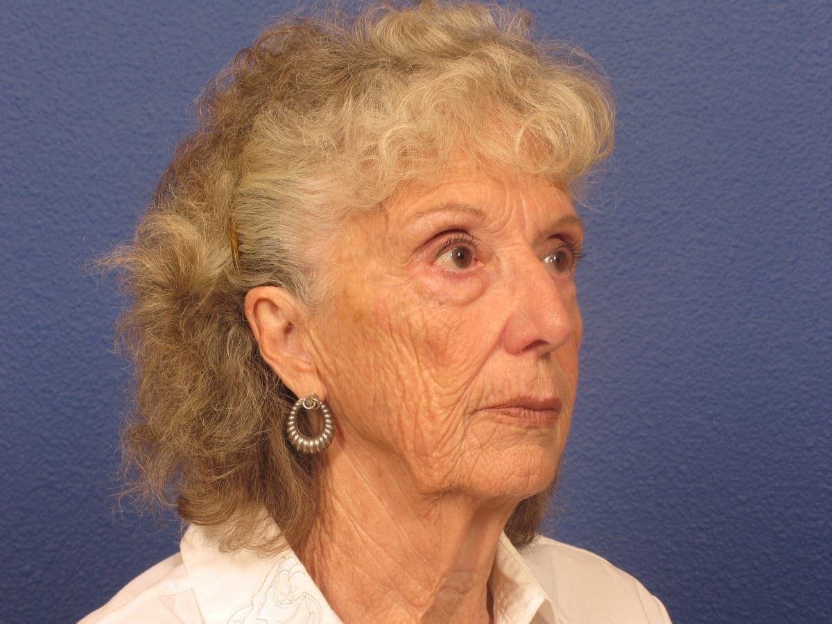 Facelift Patient Photo - Case 279 - before view-