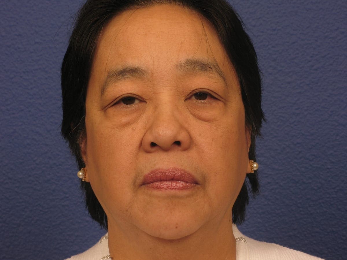 Lower Eyelid Lift Patient Photo - Case 280 - before view-2