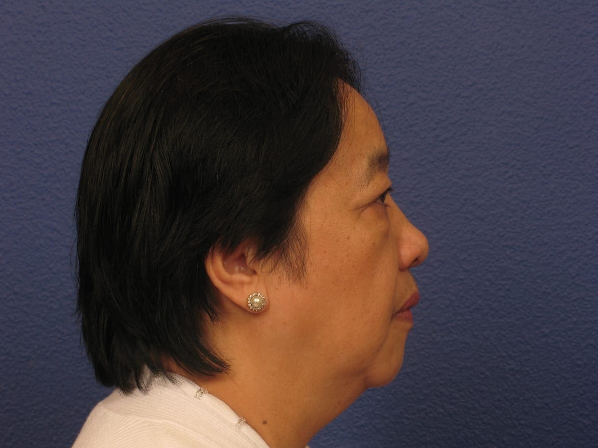 Lower Eyelid Lift Patient Photo - Case 280 - before view-