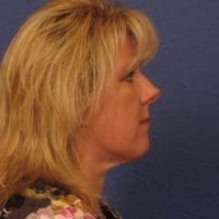 Chin Contouring - Case 288 - After