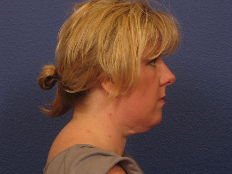 Chin Contouring - Case 288 - Before