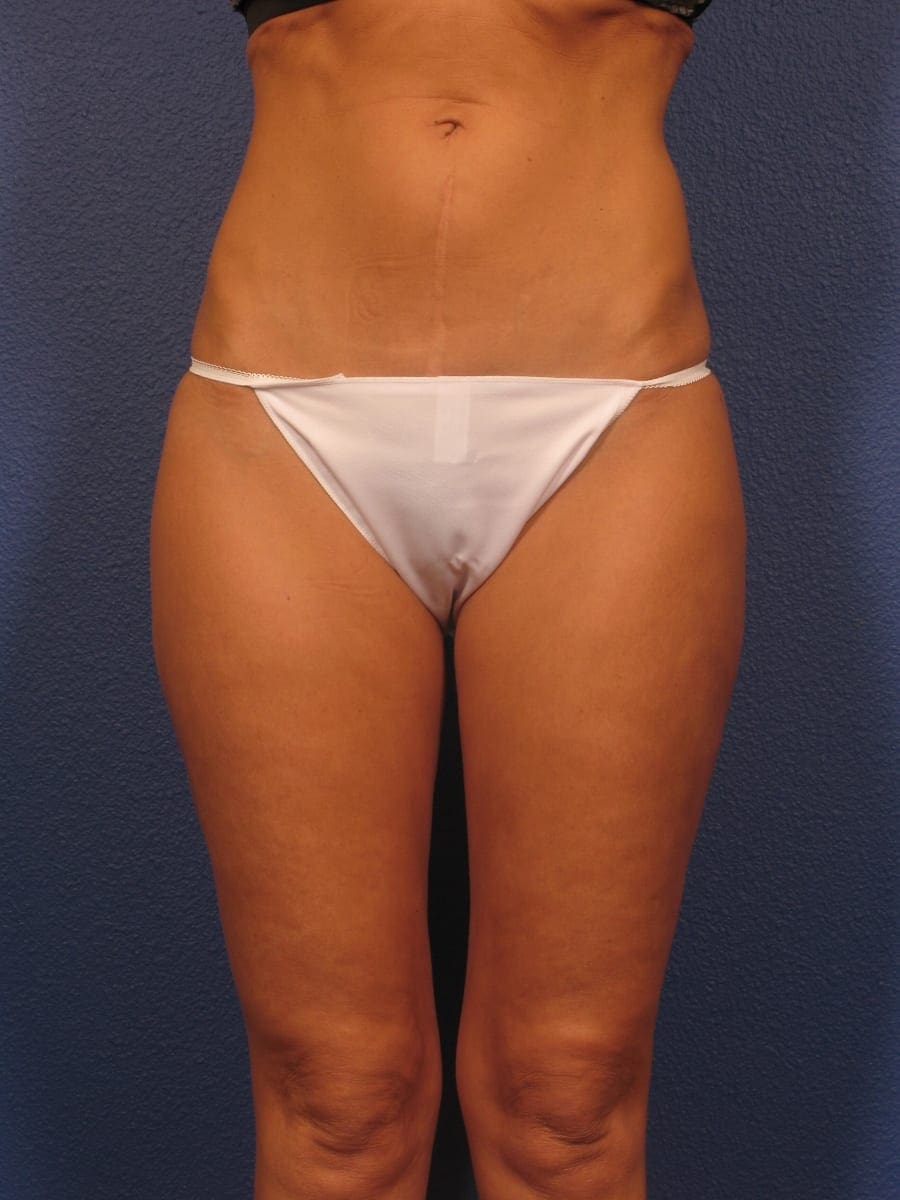Liposuction Patient Photo - Case 312 - after view-1