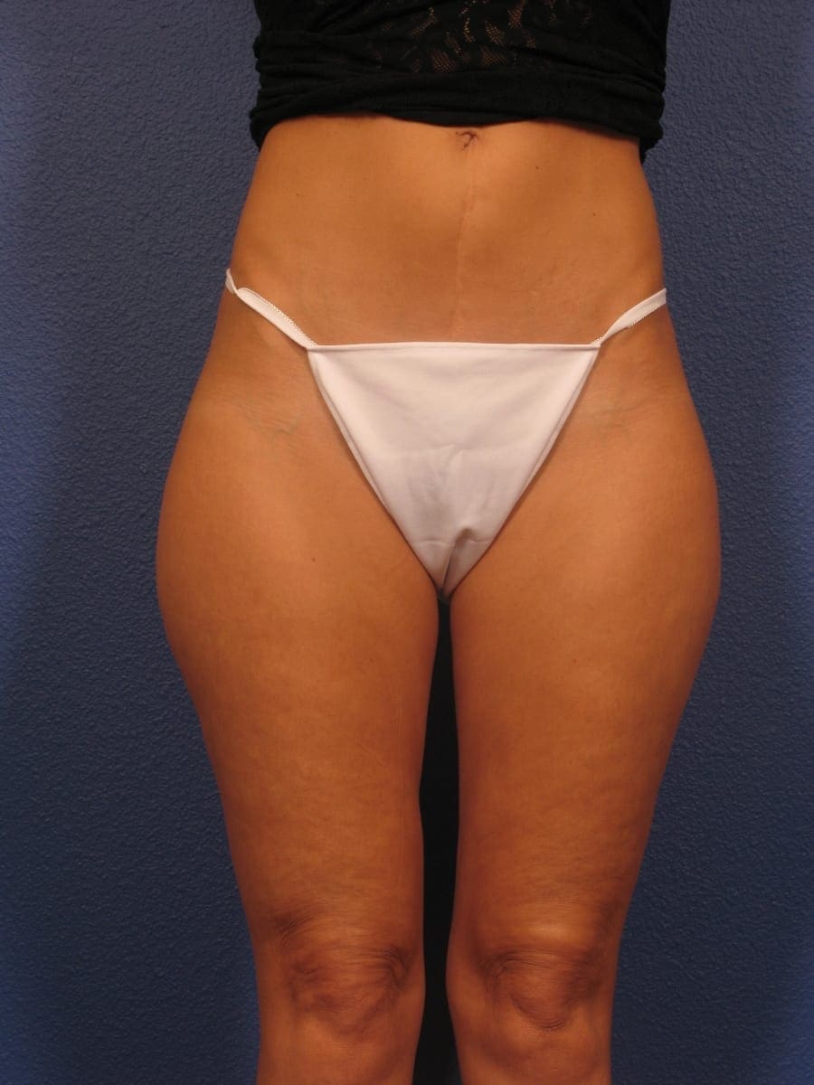 Liposuction Patient Photo - Case 312 - before view-1