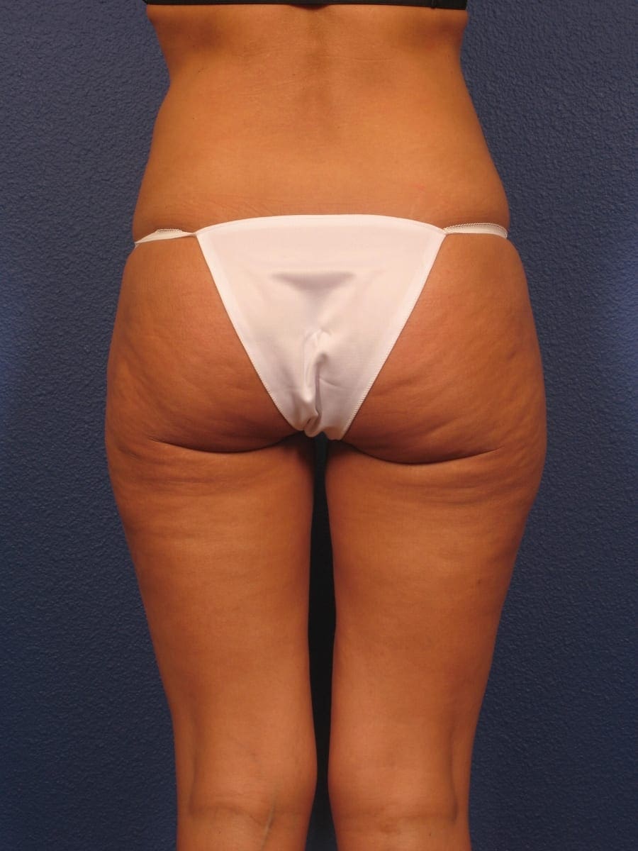 Liposuction Patient Photo - Case 312 - after view
