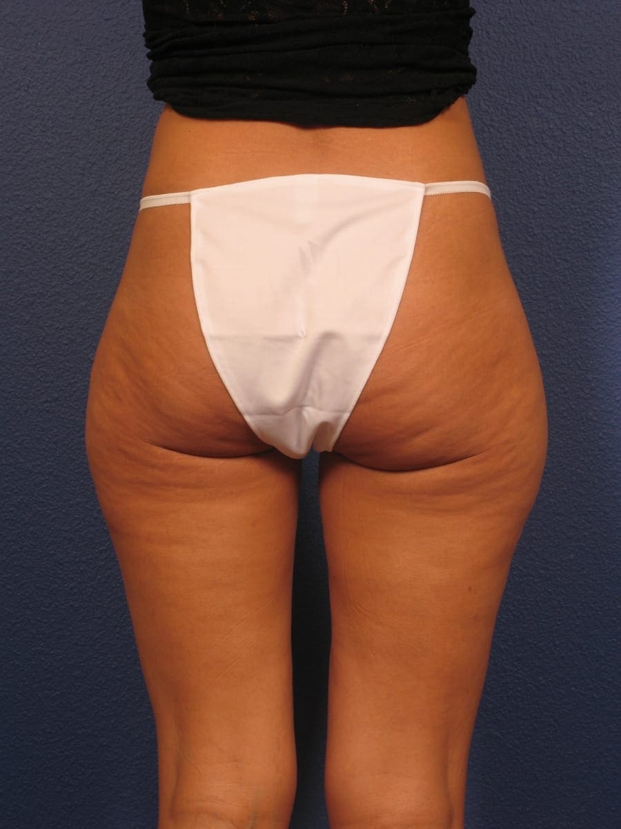 Liposuction - Case 312 - Before