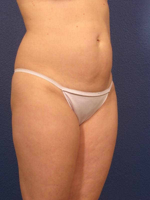 Liposuction Patient Photo - Case 166 - before view-1