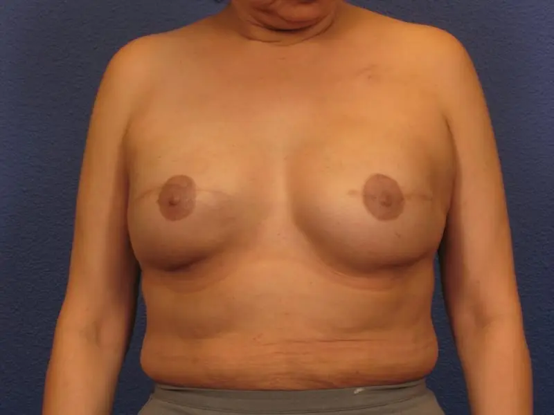 Breast Reconstruction Patient Photo - Case 318 - after view-1