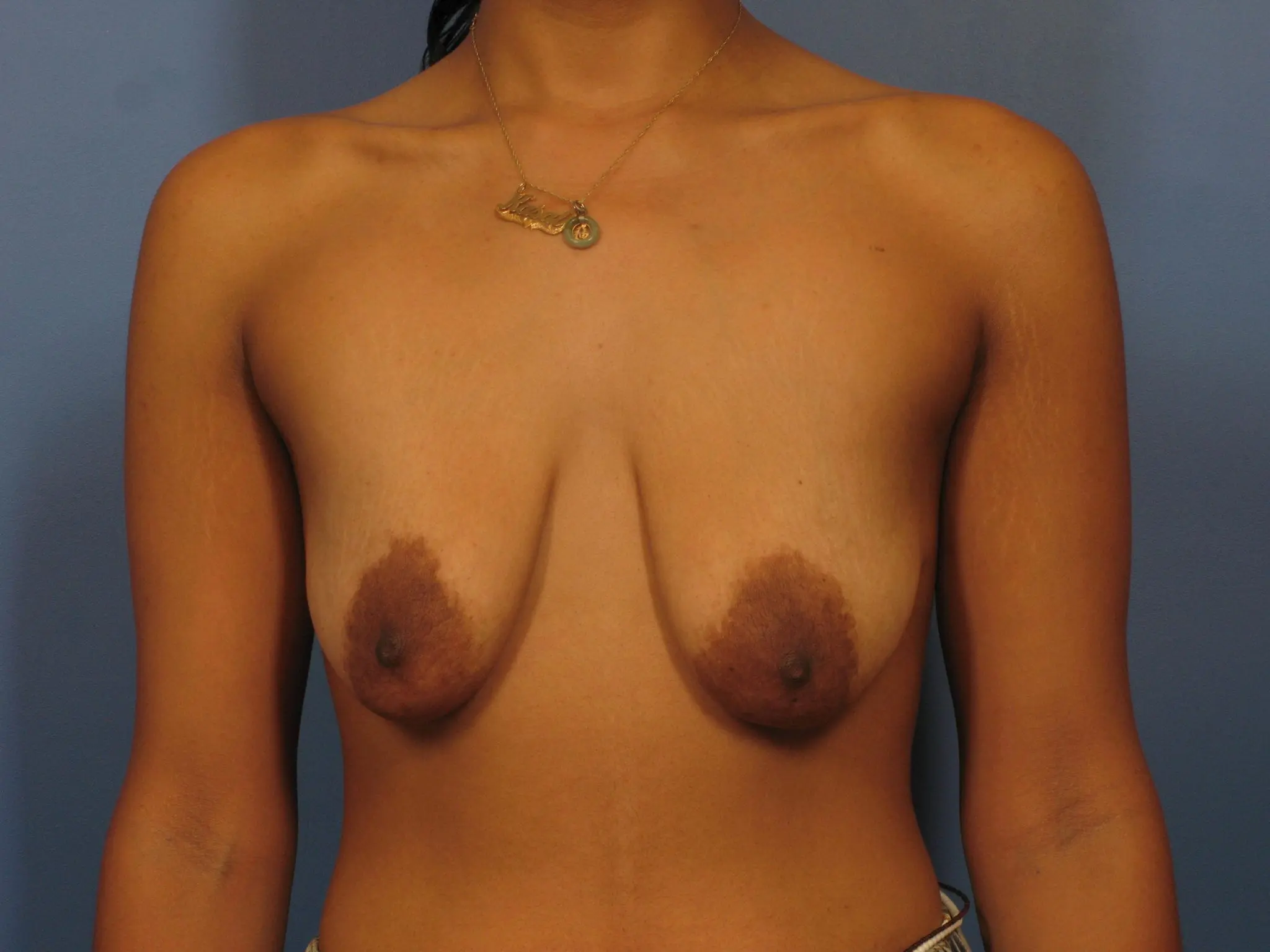 Breast Augmentation with Lift Patient Photo - Case 328 - before view-