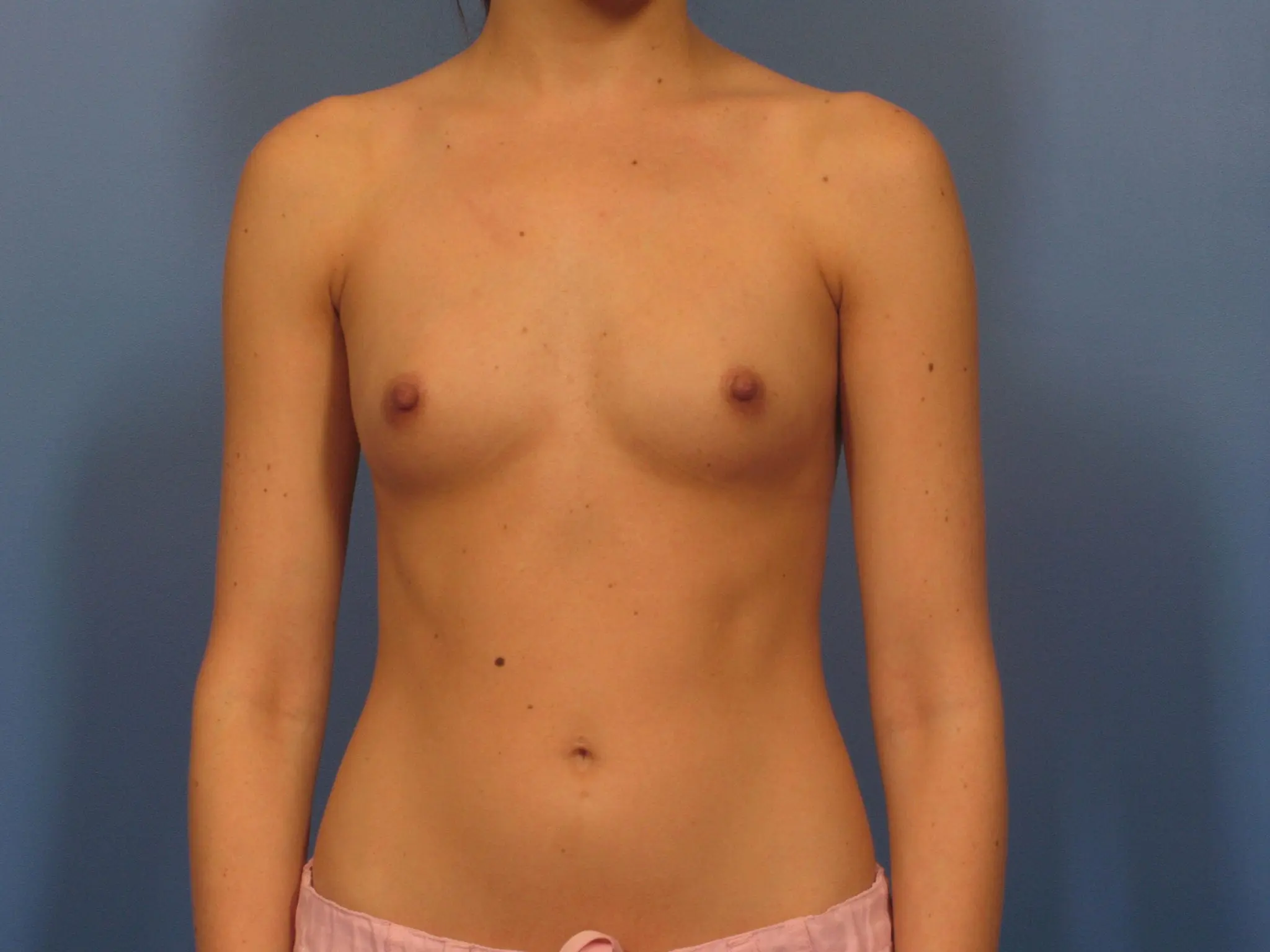 Breast Augmentation - Case 329 - Before