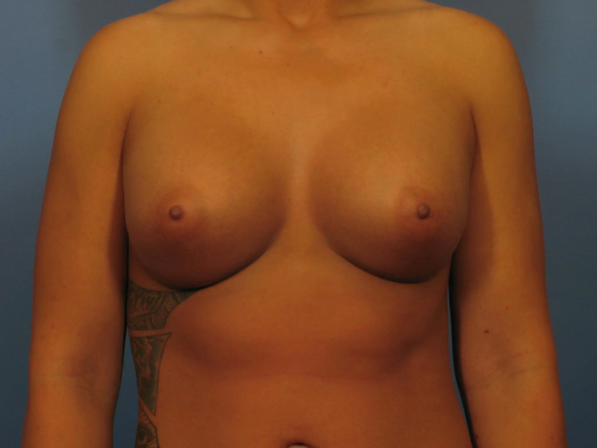 Breast Augmentation Patient Photo - Case 330 - after view