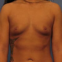 Breast Augmentation - Case 330 - Before