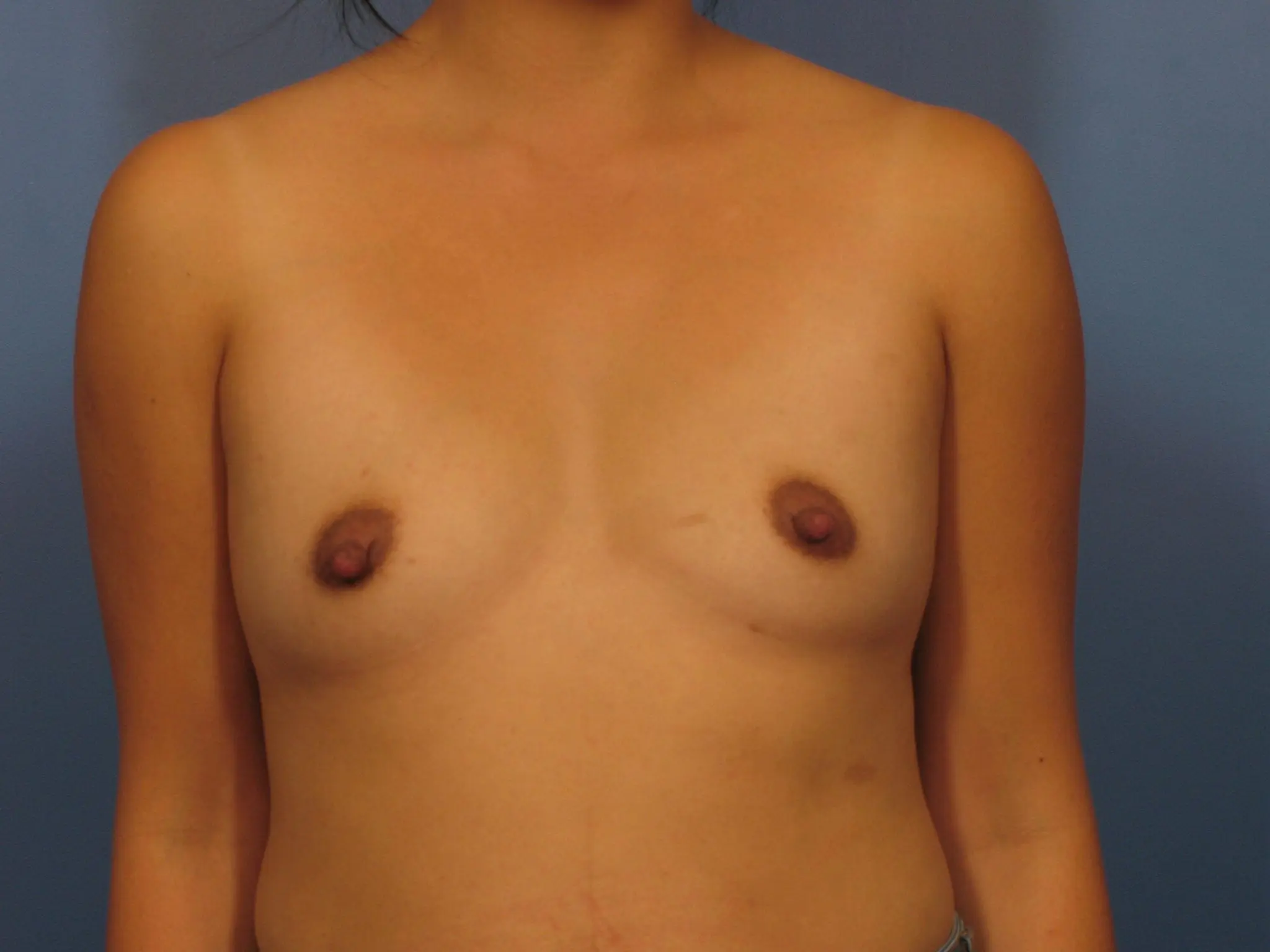 Breast Augmentation Patient Photo - Case 332 - before view-