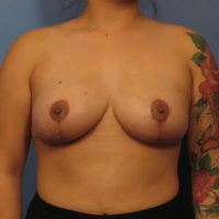 Breast Lift - Case 337 - After