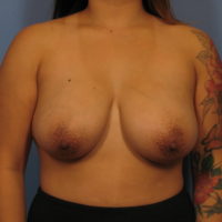 Breast Lift - Case 337 - Before